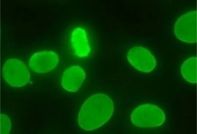 Diretrizes do VI Consenso Brasileiro para detecção de auto anticorpos contra constituintes celulares em células HEp-2