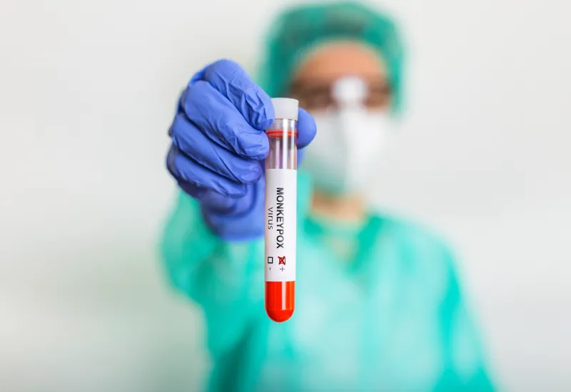Monkeypox: teste molecular é incorporado ao rol de procedimentos com cobertura obrigatória pelos planos de saúde