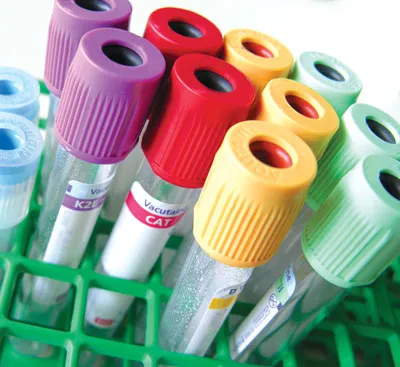 Rio tem casos de coinfecção por HIV 1 e 2, mas testes não distinguem tipo viral